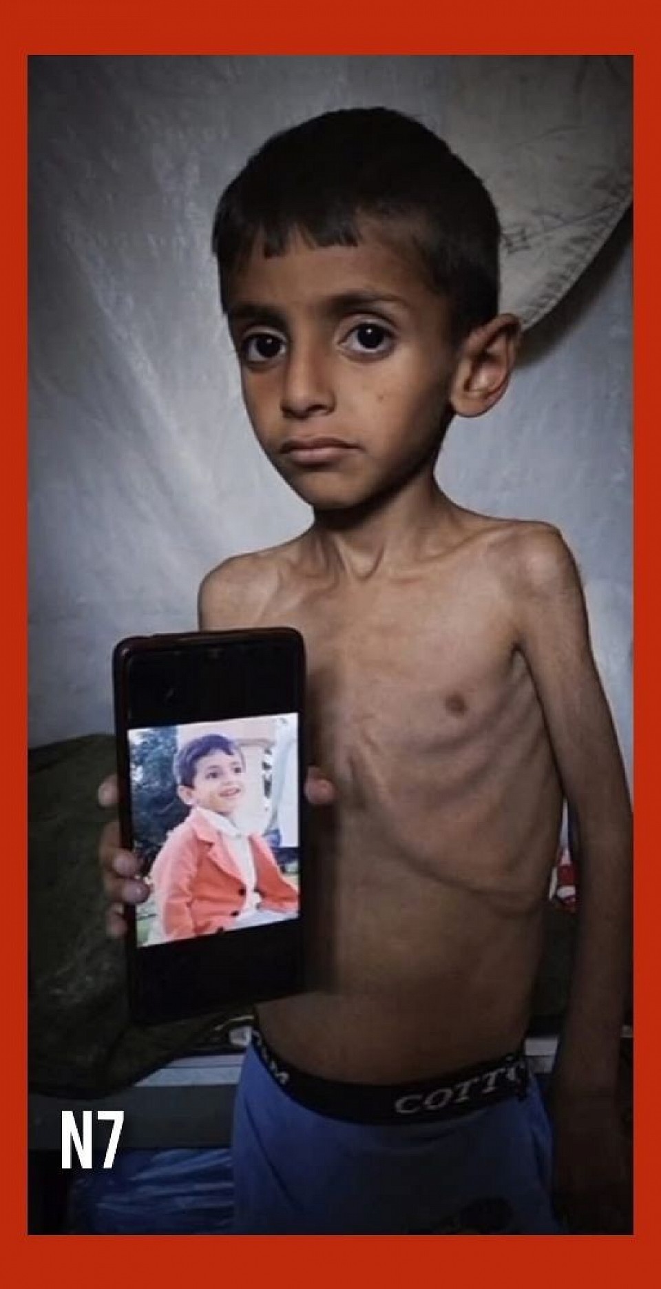 A malnourished child in Gaza holds a photo of himself in better health, highlighting the severe impact of famine on more than one million children, according to Reuters (January 2025). According to the United Nations World Food Programme, 131 million children worldwide face acute food crises. A 2024 study in Malawi (University of Liverpool/Malawi-Liverpool Wellcome Trust) followed 1,024 children treated for acute malnutrition and showed long-term health effects such as stunted growth and delayed cognition. This confirms the publication's warning about the lasting effects of hunger on Gaza's children, despite recent aid increases following the January 2025 truce between Israel and Hamas.